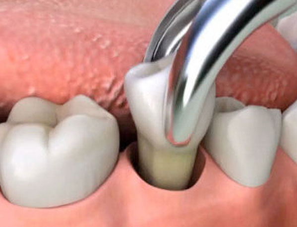 Dental Extraction