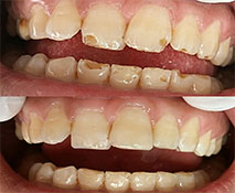 Dental Fillings - Seville Dental Clinic