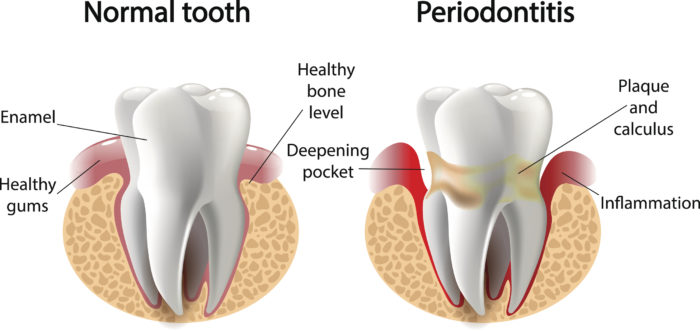 Gum Disease - Seville Dental Clinic